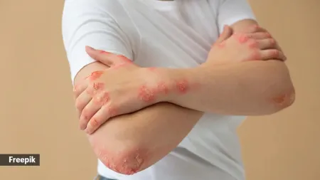 Can weight loss help in treating psoriasis?