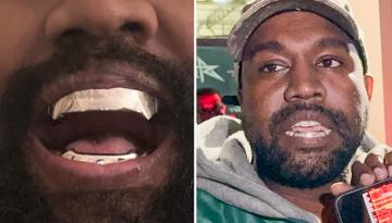 Kanye West seemingly replaces teeth with 'epic' $13.9m titanium dentures