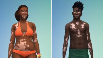 The Sims 4 adds new vitiligo skin feature to diversify representation in the game