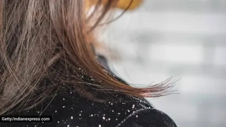 Can the ‘C’ company of camphor (kapur), coconut oil cure dandruff? Experts weigh in