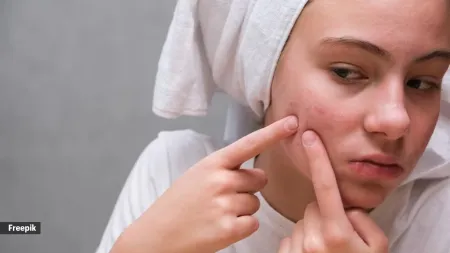 Are pimple patches the ultimate acne solution? Dermatologists answers