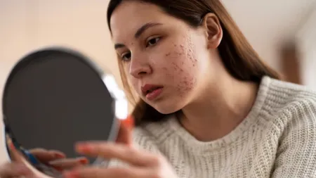 Acne that won’t go away: Here are the reasons why those acne-reducing creams aren’t working