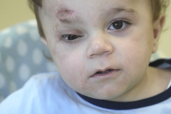 A baby evacuated from Gaza lost an eye and most of his family in the war